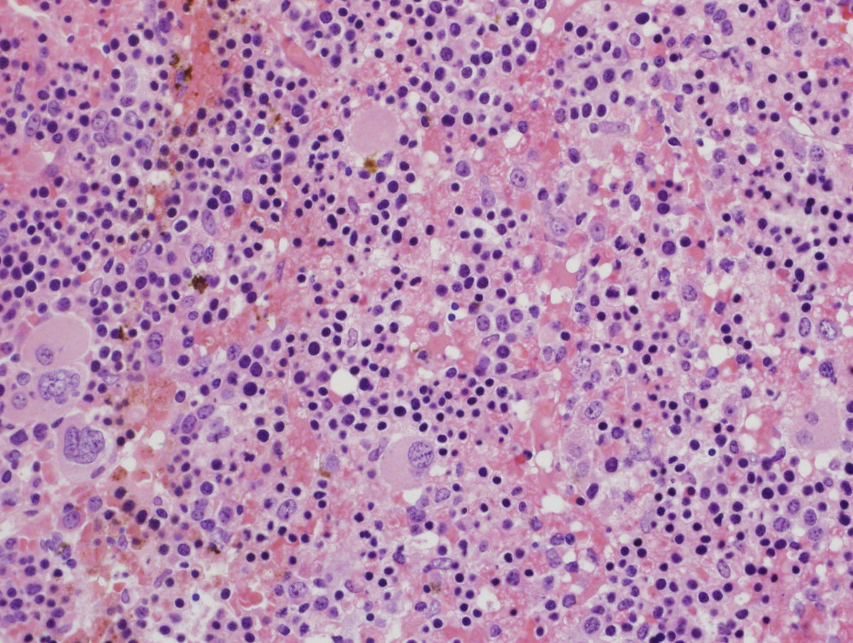Bone Marrow Biopsy, H & E, 40X